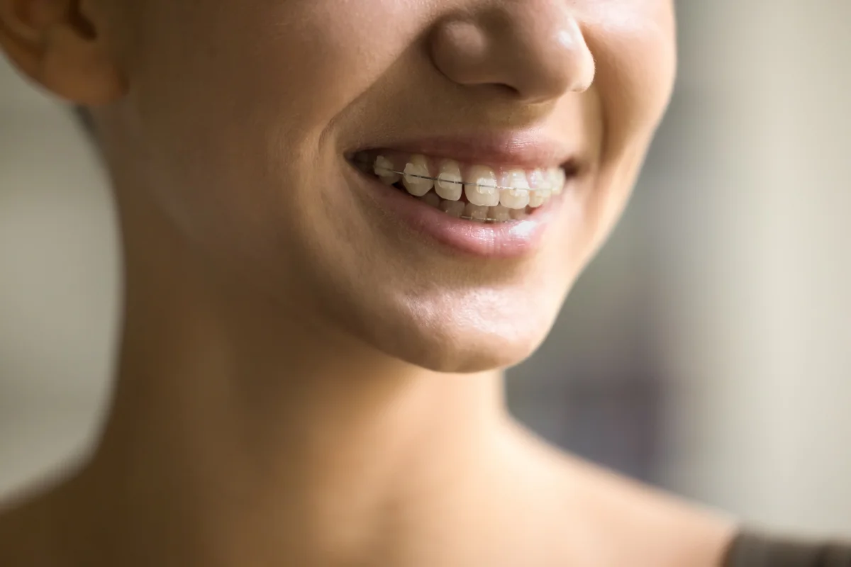 Close-up of tooth-coloured ceramic braces on a smiling patient