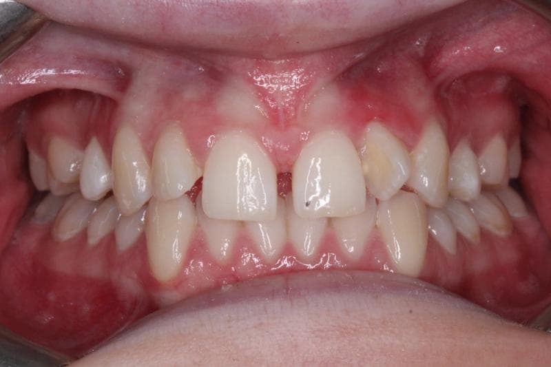Francesca - before and after treatment