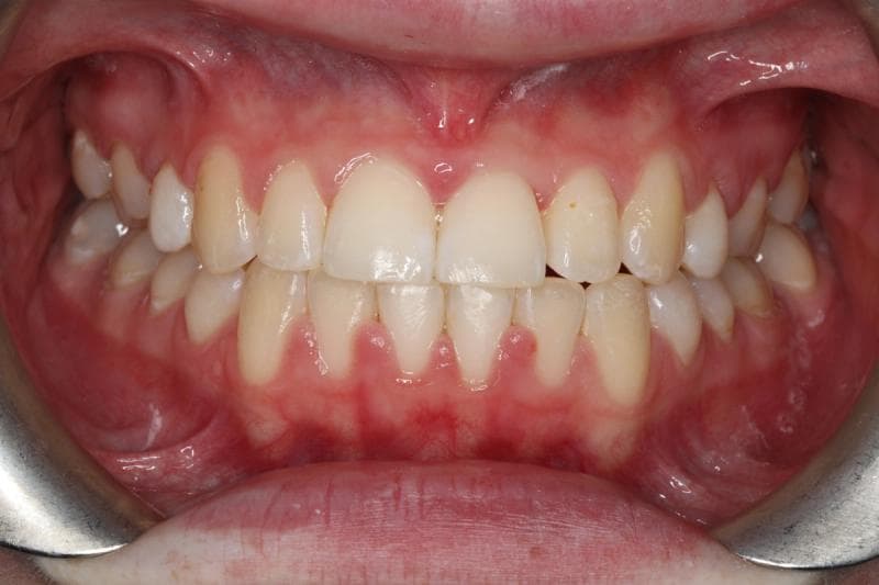 HH - before and after treatment