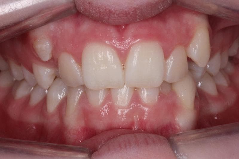 RA - before and after treatment