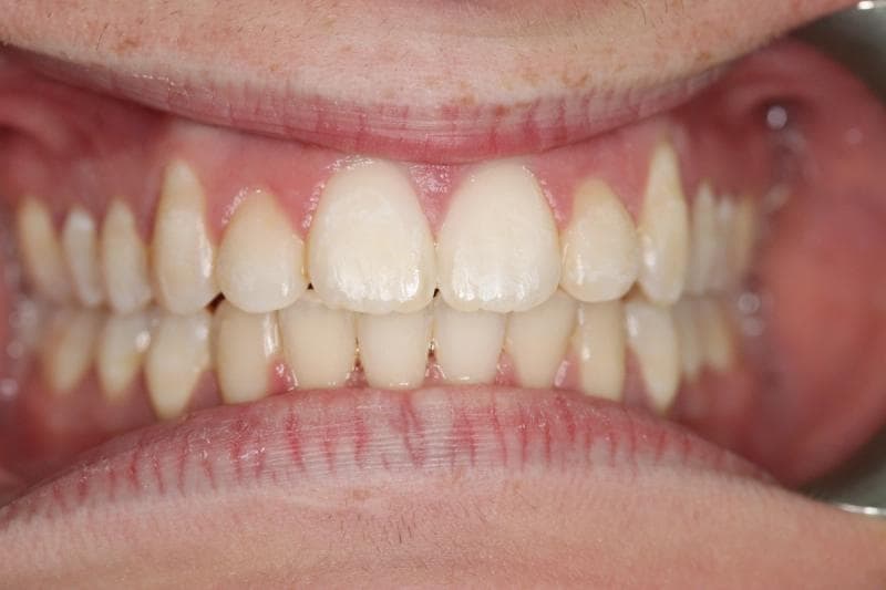 SK - before and after treatment