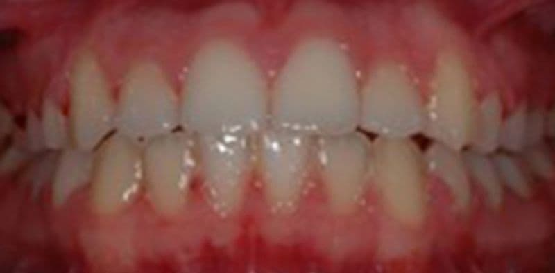 Aria - before treatment