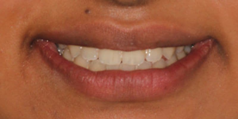 Harry - before treatment