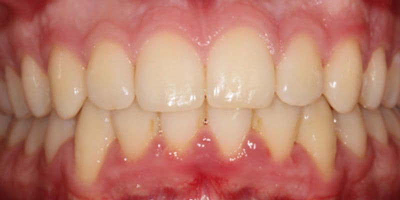 Harry - after treatment