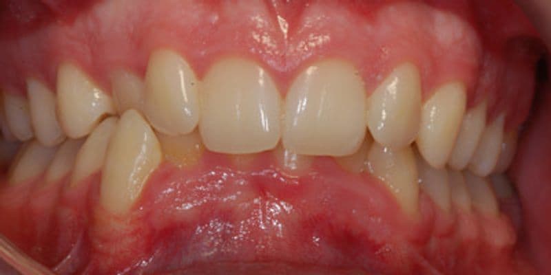 Kathryn - before treatment
