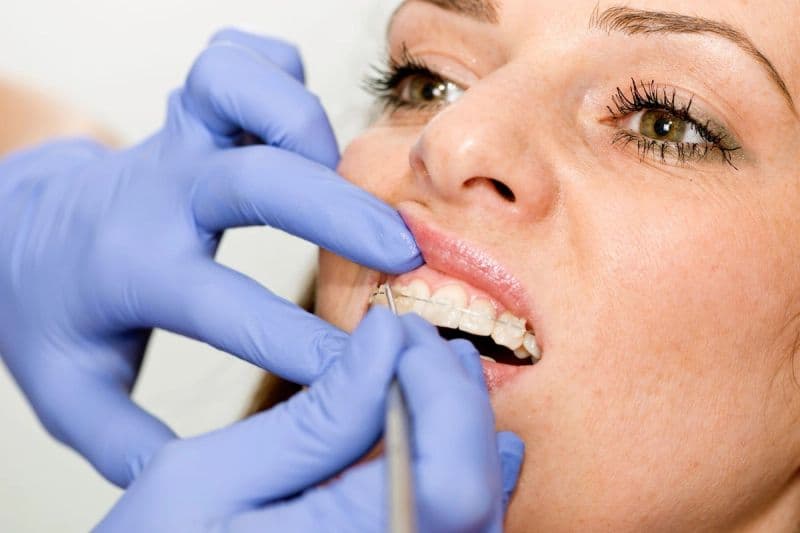 Ceramic Braces