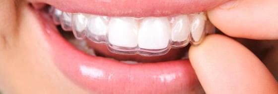 Ceramic braces treatment