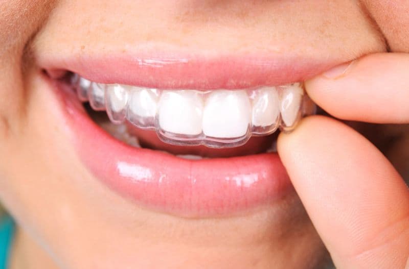 Invisalign
