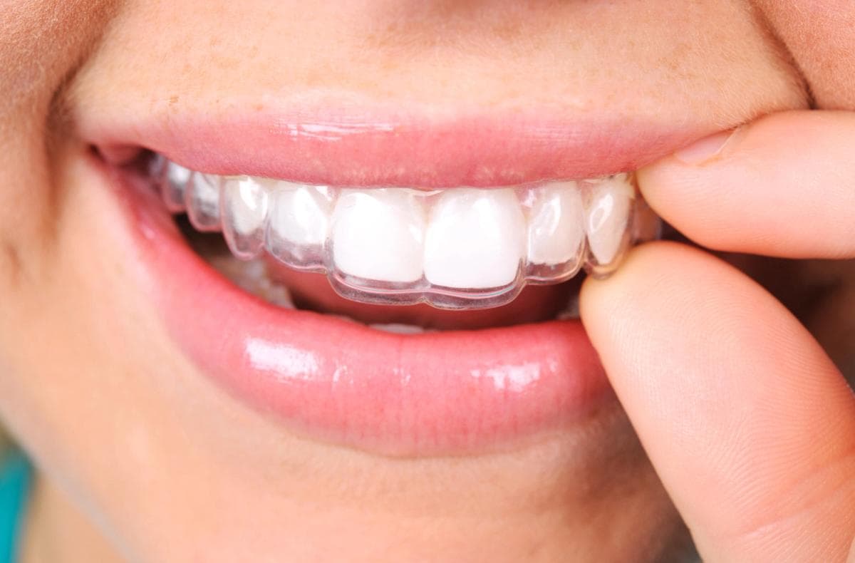 Invisalign treatment journey