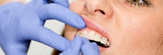 Invisalign