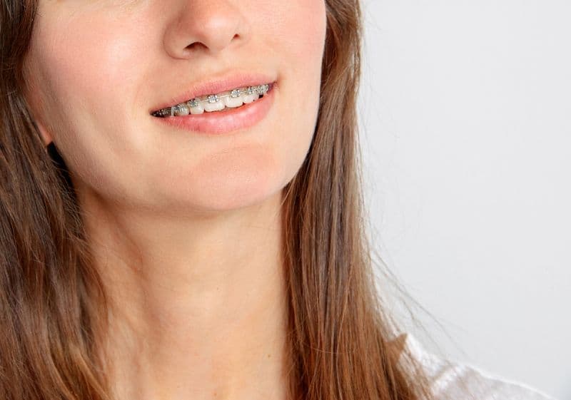 Fixed Metal Braces