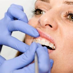 Ceramic braces