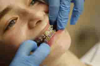 A young patient with colourful orthodontic modules on her fixed brace