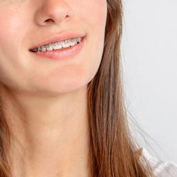 Metal braces